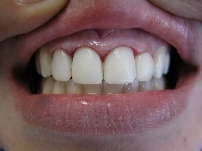 The same patient's teeth after treatment at Dynamic Dental Arts, case 03