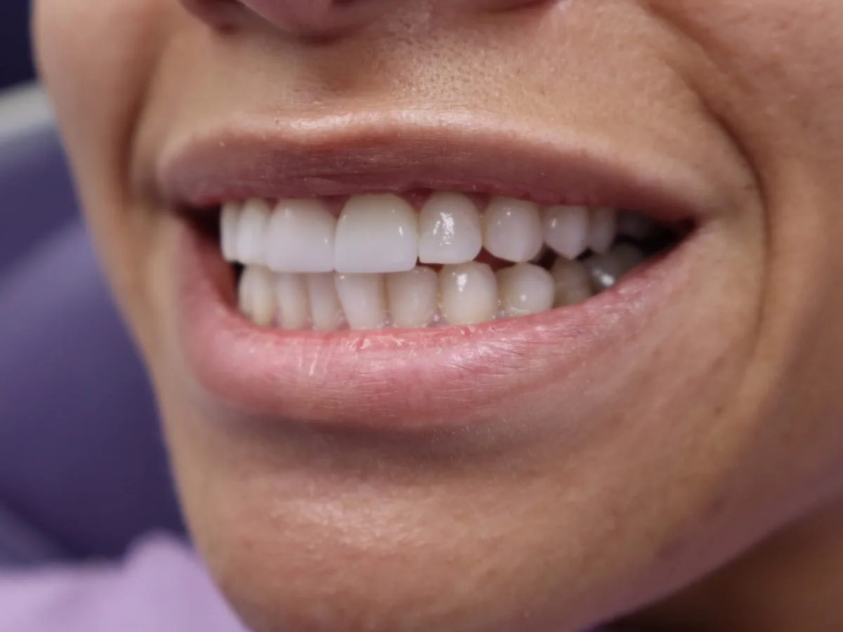 The same patient's teeth after treatment at Dynamic Dental Arts, case 09