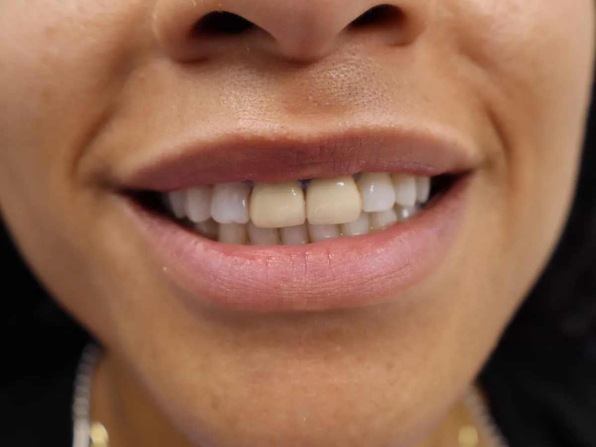 Close-up of a patient's teeth before treatment at Dynamic Dental Arts, case 09