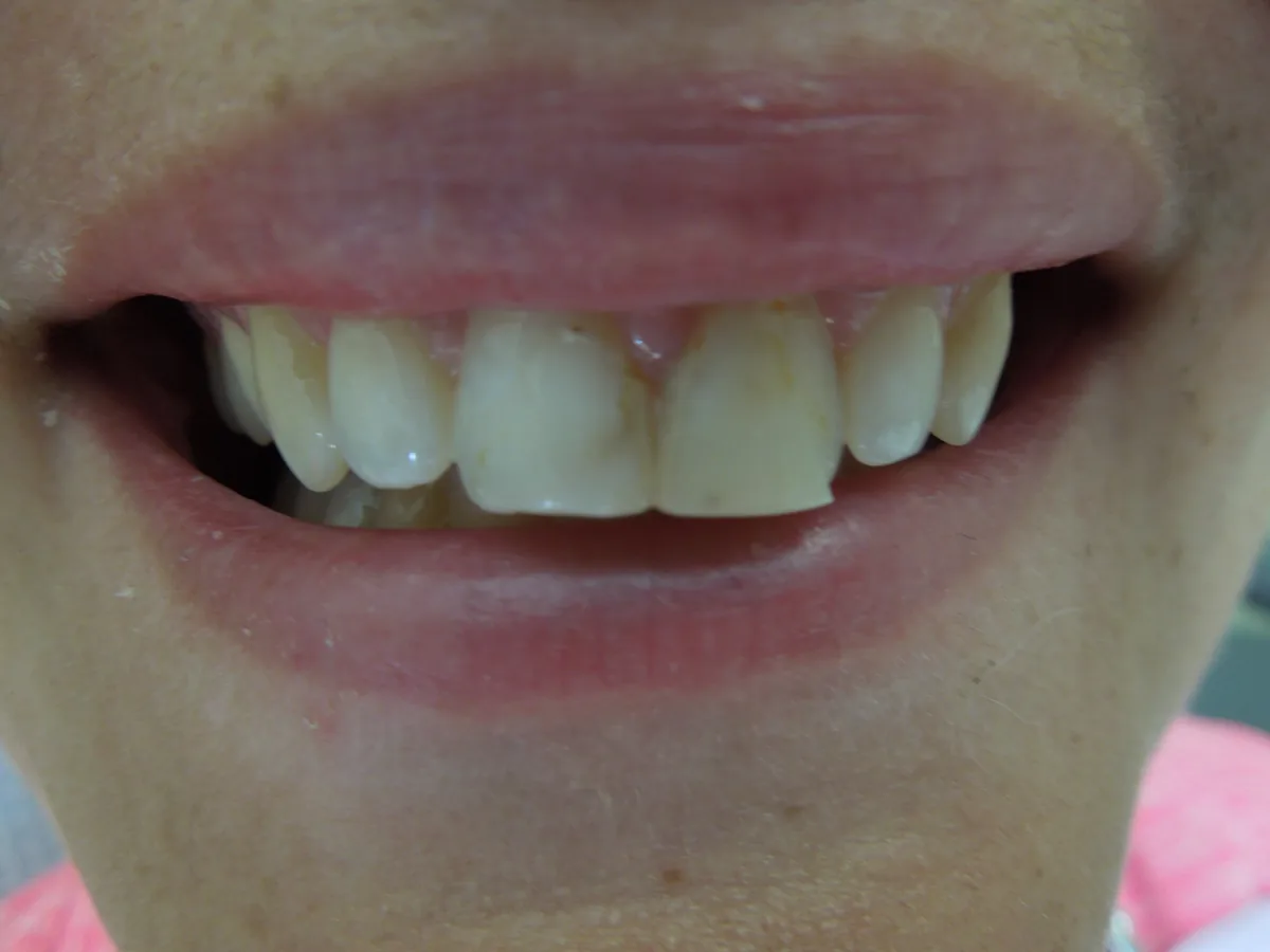 Close-up of a patient's teeth before treatment at Dynamic Dental Arts, case 16