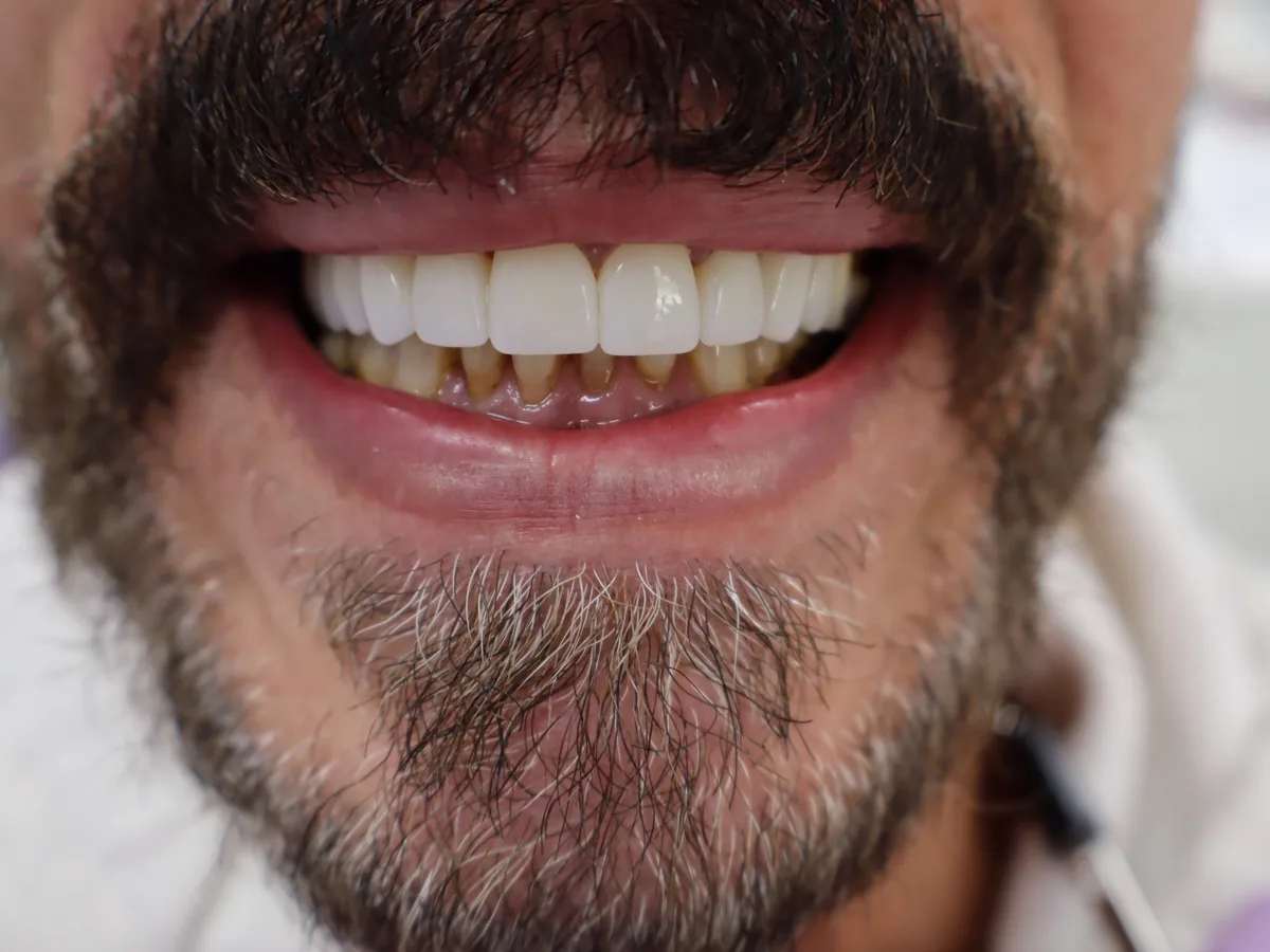The same patient's teeth after treatment at Dynamic Dental Arts, case 10
